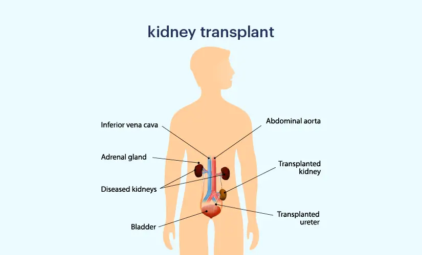 Kidney Tranplant